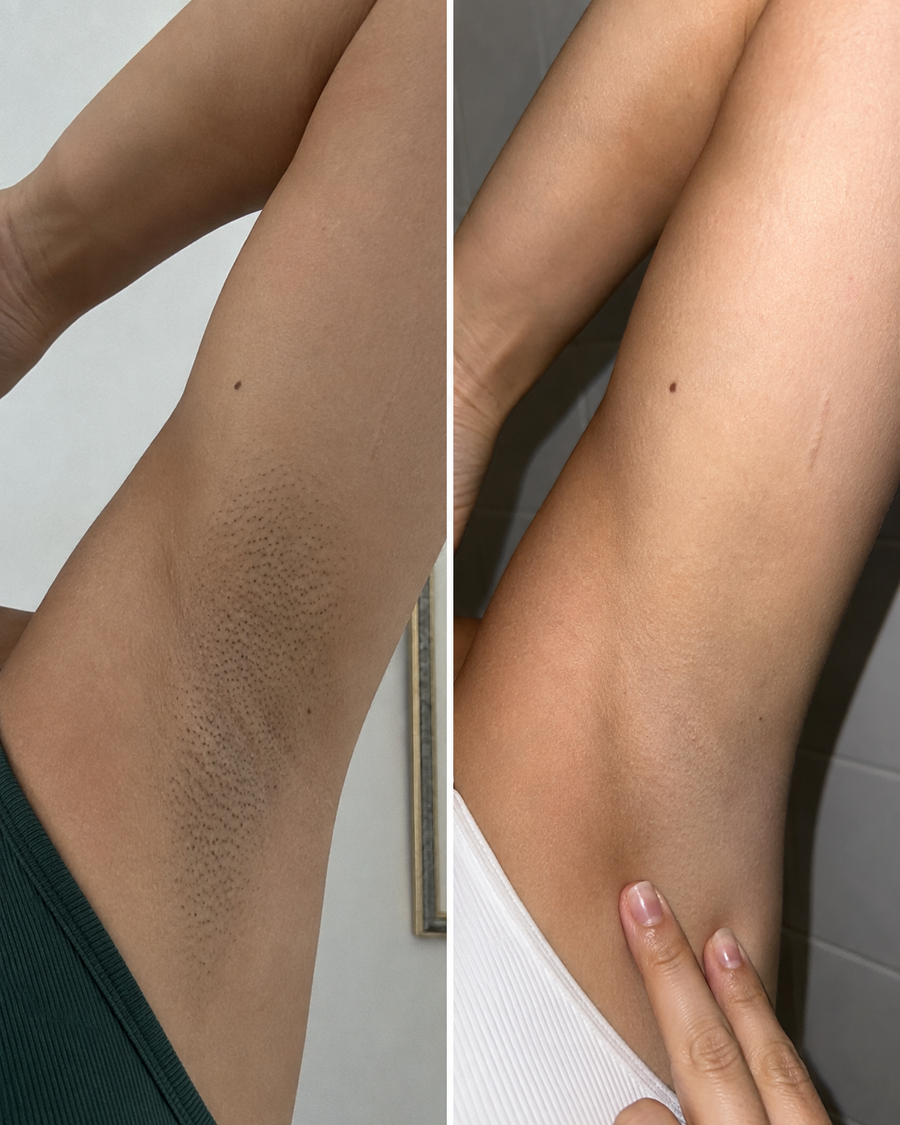 Antes y despues de axila, resultado real