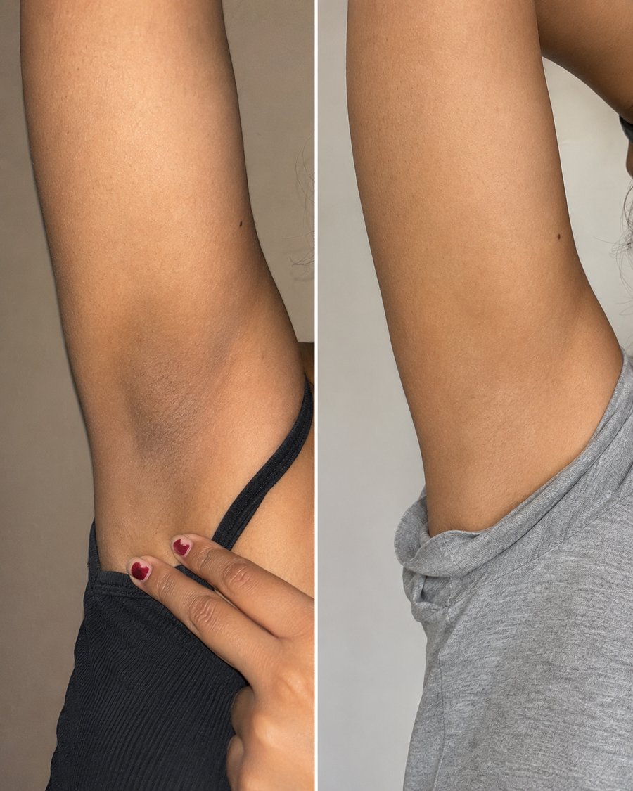 Antes y despues de axila, resultado real