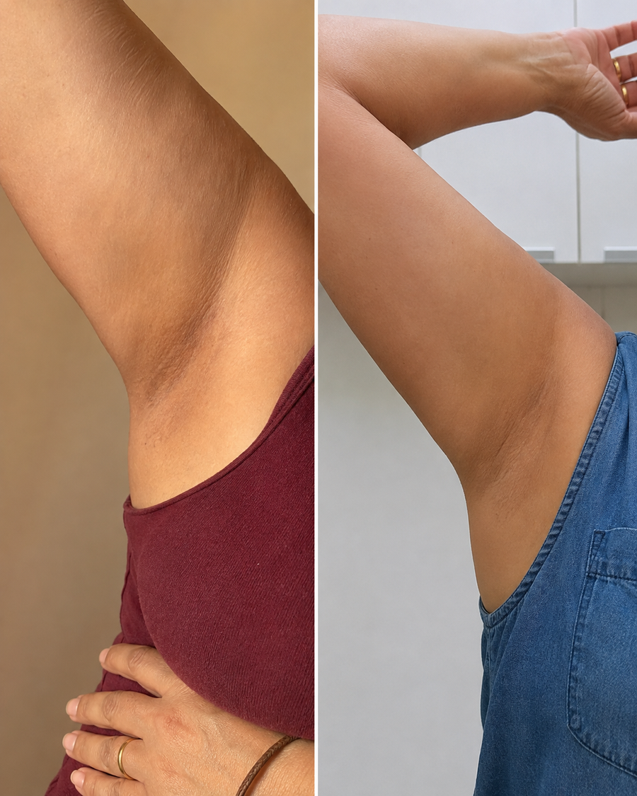 Antes y despues de axila, resultado real